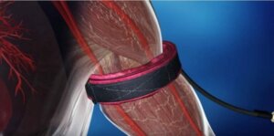 ograniczenie przepływu krwi