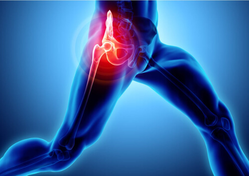 Zapalenie kaletki krętarzowej